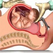 Five Ways to Avoid a C-Section
