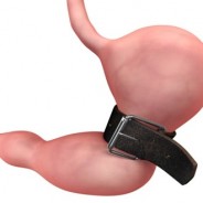 Weight Loss Surgery and Going Vegan